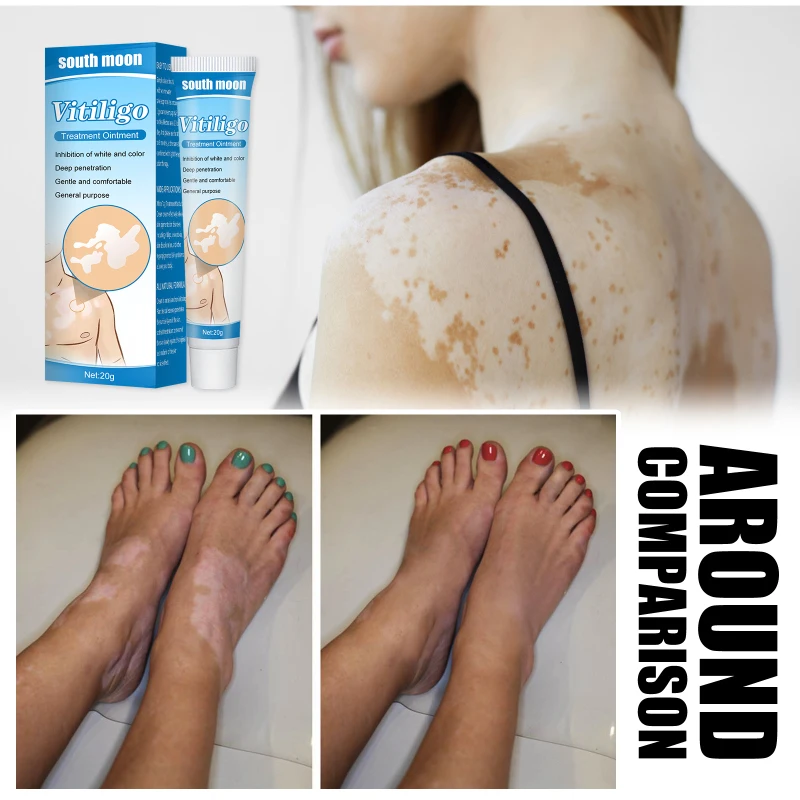 

EELHOE 20g White Spot Disease Treatments Ointment Leukoplakia Disease Melanin Cream Body Care Vitiligo Balm Repair Creams