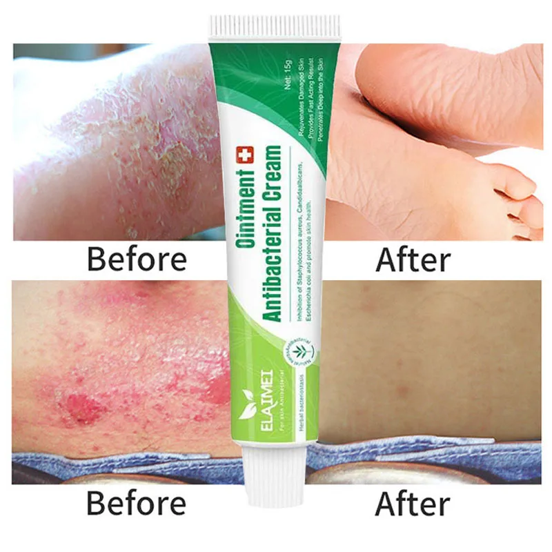 Травяная мазь антибактериальный крем от псориаза |