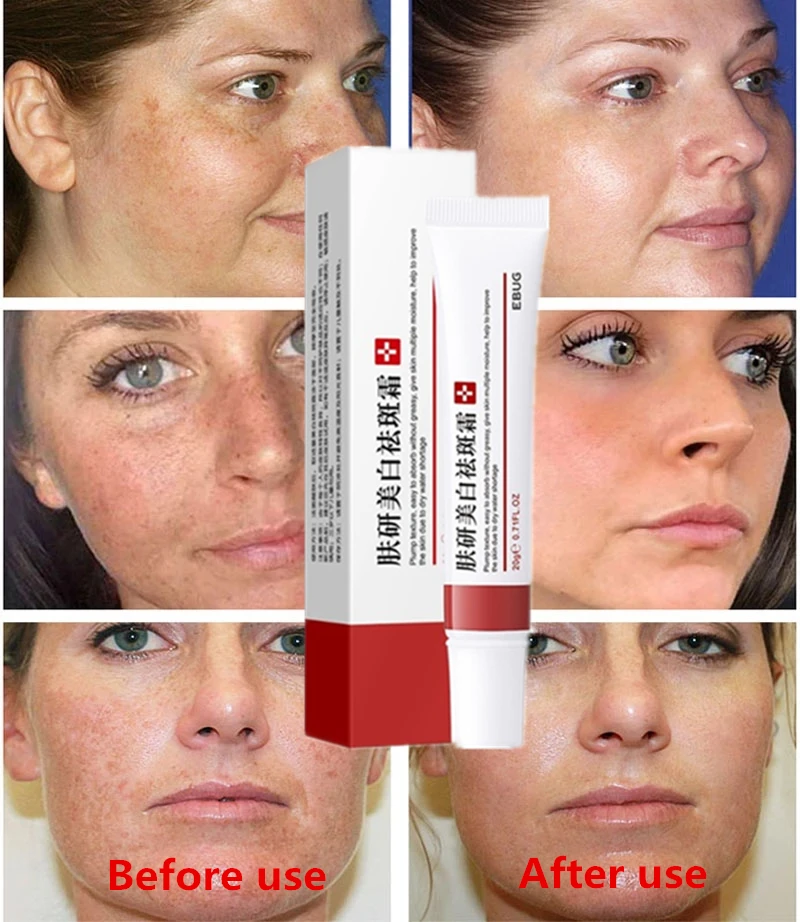 

Effective Freckle Cream Remove Dark Spots Acne Spot Pigment Melanin Dark Spots Pigmentation Moisturizing Gel Skin Care Facial