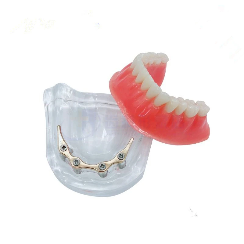 Overdenture implant model Denture Teeth mandibular with golden bar Dental Teaching Model | Красота и здоровье