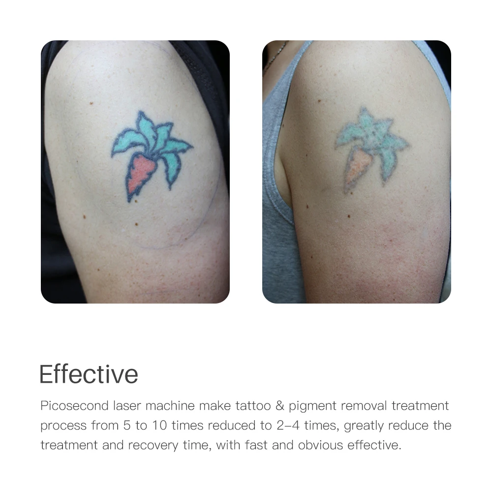 Профессиональная лазерная ручка для пикосекунды сине красная световая терапия