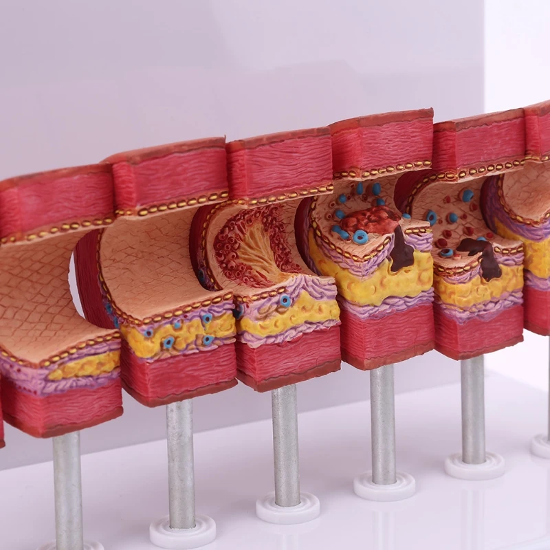 

Human Atherosclerosis Model Artery Pathology Anatomical Blood Vessel Anatomy Thrombus