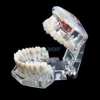 1pcs dental implant disease teeth model with restoration bridge for medical science dentistry tooth disease teaching study
