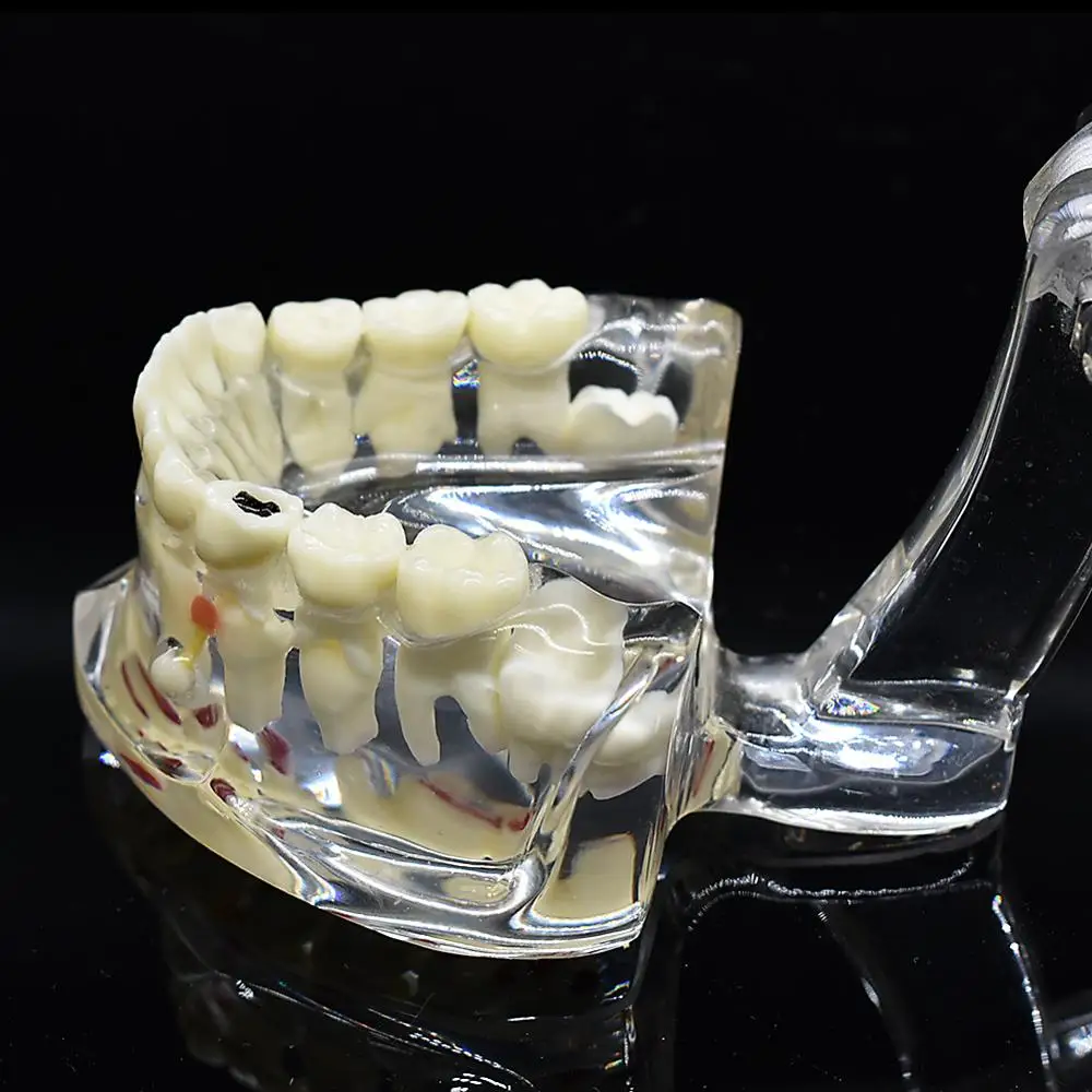 Стоматологическая детская модель патологических зубов Ортодонтическая для