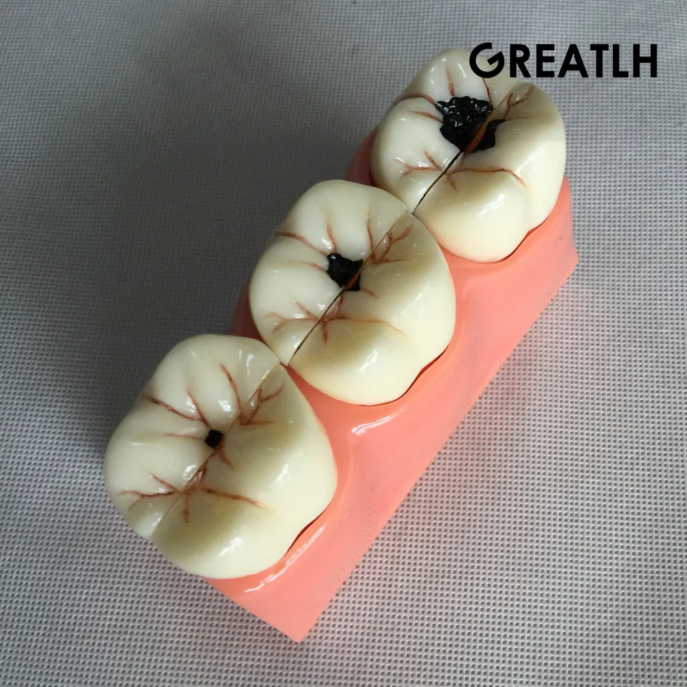 Модель зуба для зубов съемные зубы размер 4:1 обучающая модель|tooth model|removable teethdental