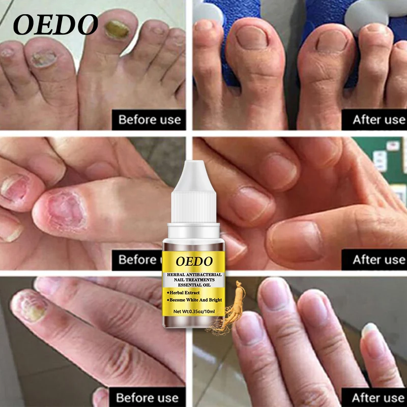 2 шт./лот антибактериальное масло для лечения Ногтей растительный экстракт