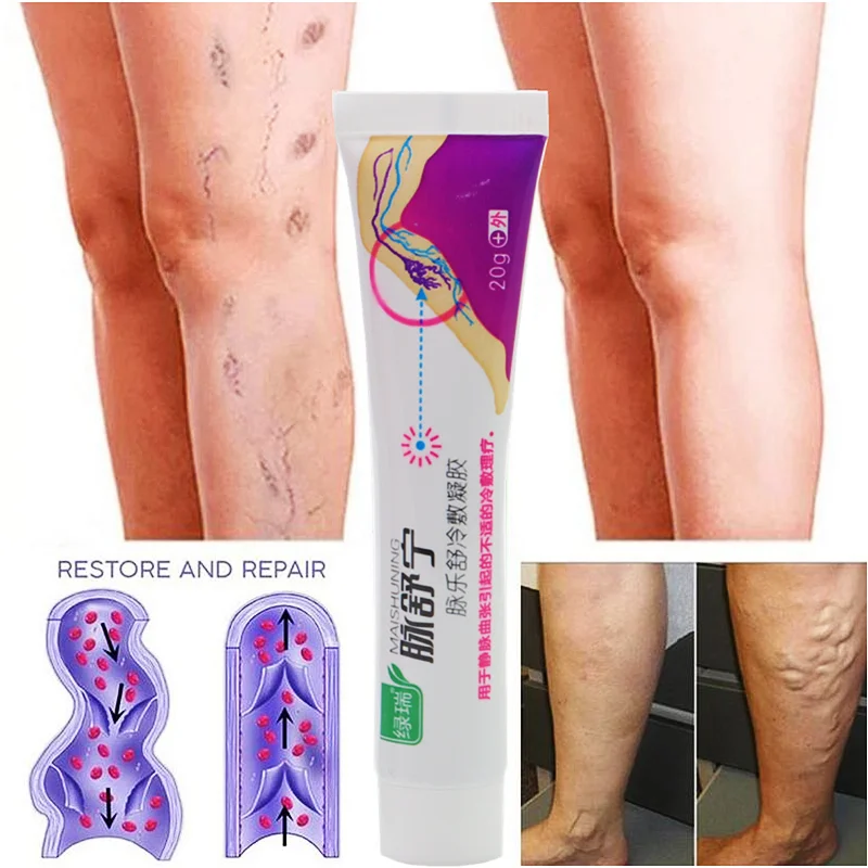 

20g Varicose Vein Cold Compress Gel Phlebitis Vasculitis Swelling Relieve Leg Pain Vasculitis Care Varicose Vein Ointment