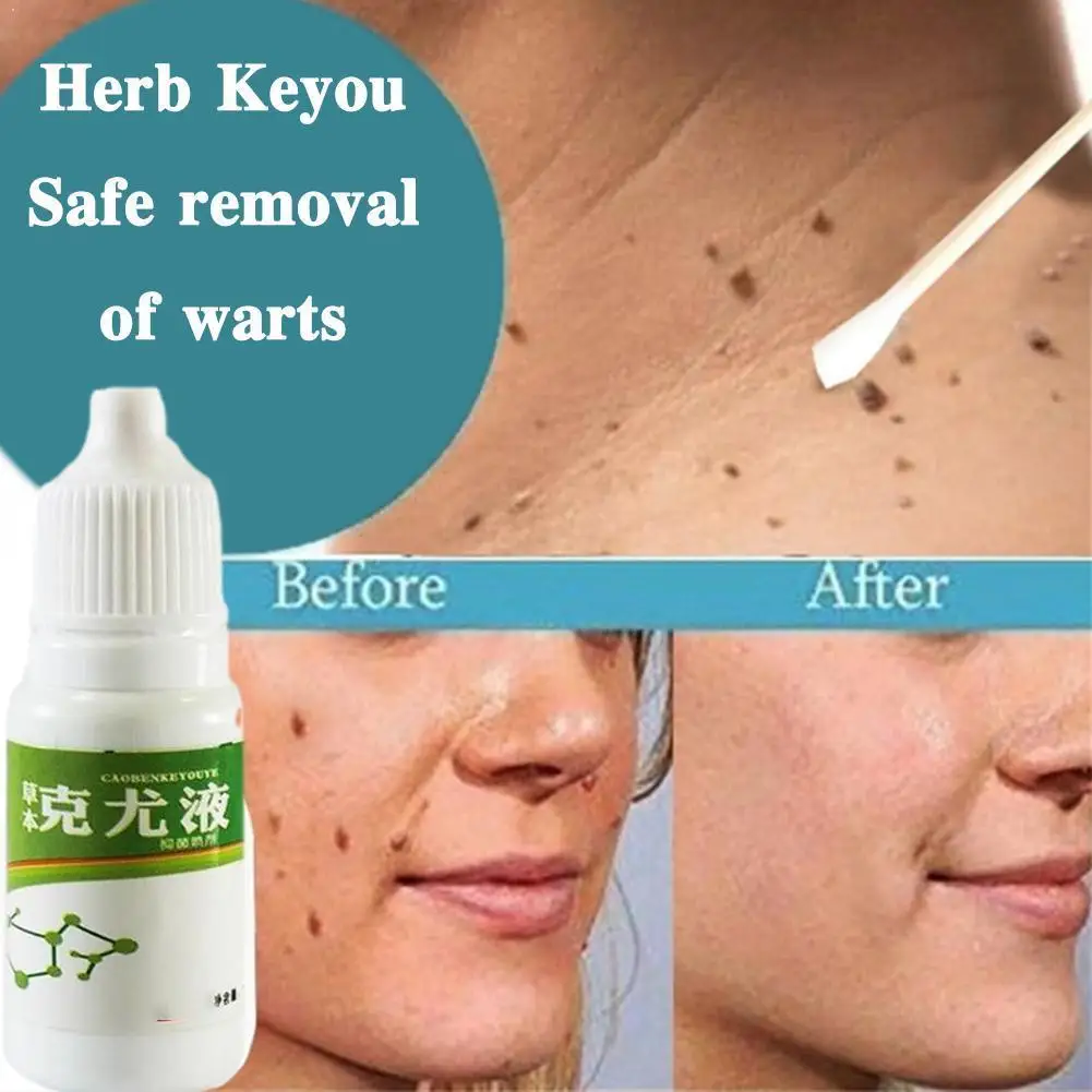 

Genital Warts Treatment Papillomas Removal Warts Fluid Remedy Against Anti Moles Tags Wart Skin Removal From 10Ml Remover K0D9