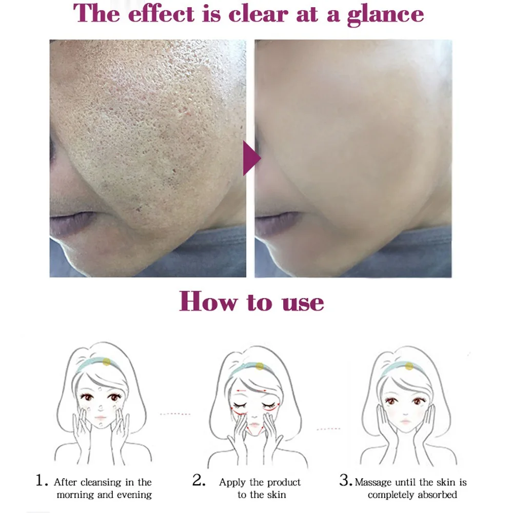 1 шт. средство для удаления акне и угрей RtopR лечение отбеливание пор уход за кожей