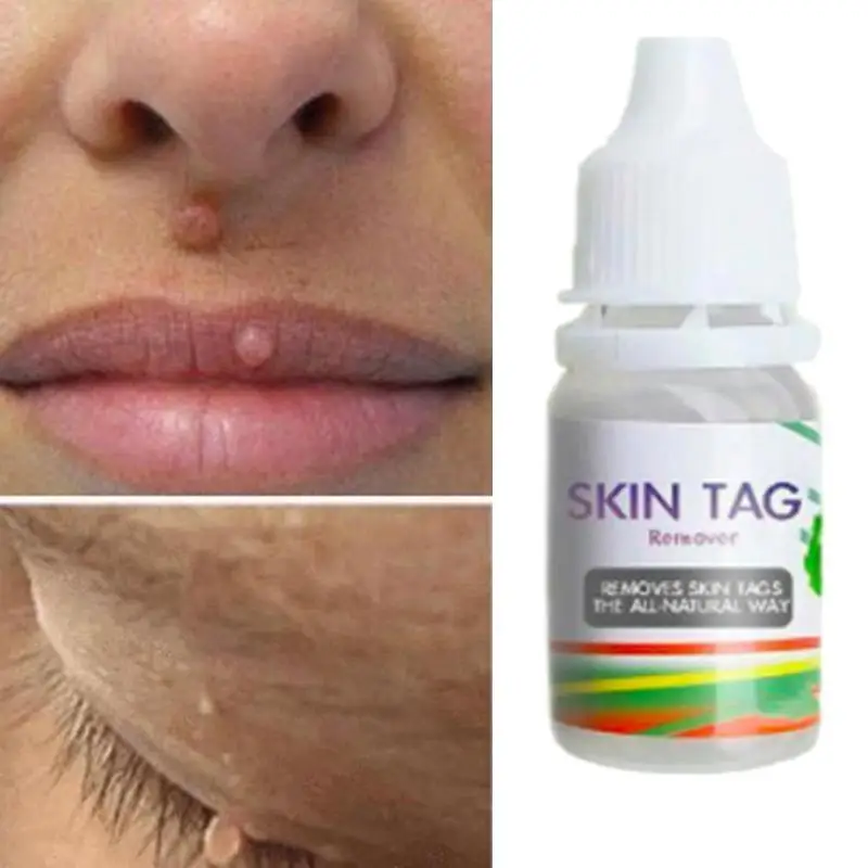 

Skin Tag Remover Wart Treatment Papillomas Removal Liquid Against Moles Remover Anti Verruca Remedy Ointment 10Ml