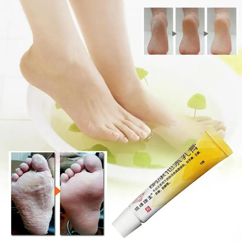 

Ketocontaxol Cream Analgesic Cream Suitable For Hand And Foot Ringworm Herbal Ointment