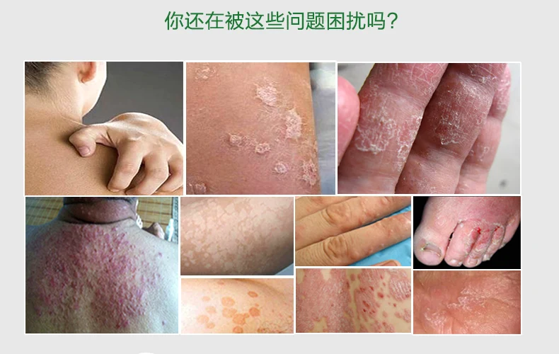 

18g/36g Special Antibacterial cream 18g/bottle for eliminate sweat stain tinea versicolor tinea cutis