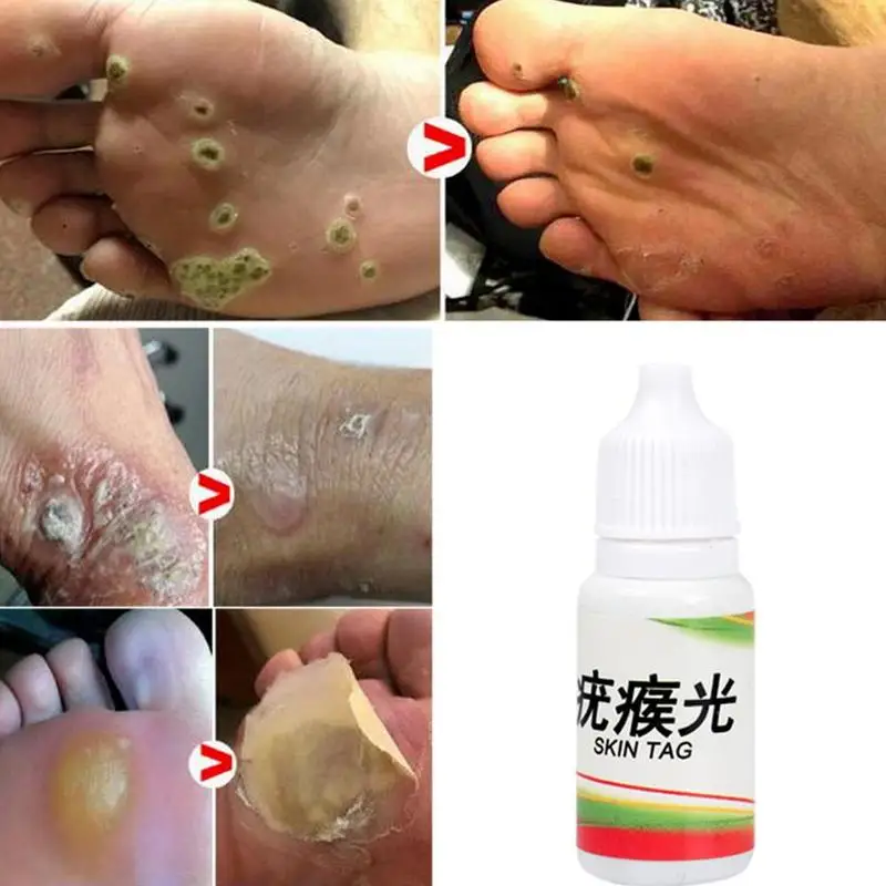 10 мл кожу средство удаления бирок моль женских половых органов для бородавок