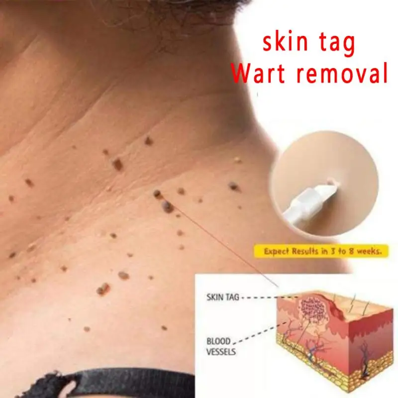 

10ml Skin Tag Remover Chinese Medicine Treatment Skin Warts Removal Plantar warts Skin Care Ointment TSLM1