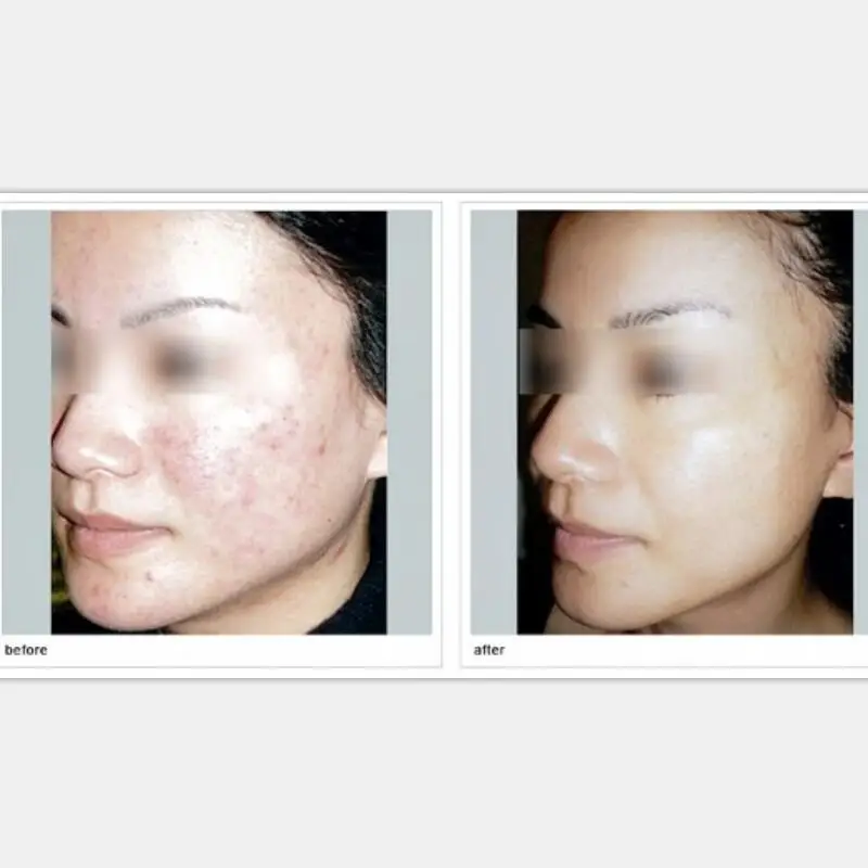 

Anti-inflammatory, anti-oxidant, comprehensive repair of tissues and wounds, increase elasticity, and dilute acne marks. 20g gel