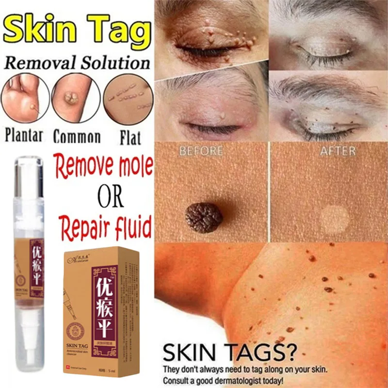

Skin Tag Remover Against Mole & Genital Wart fast RemovWithin al Anti Foot Corn Removal Warts Papillomas Rapidly Removes Moles