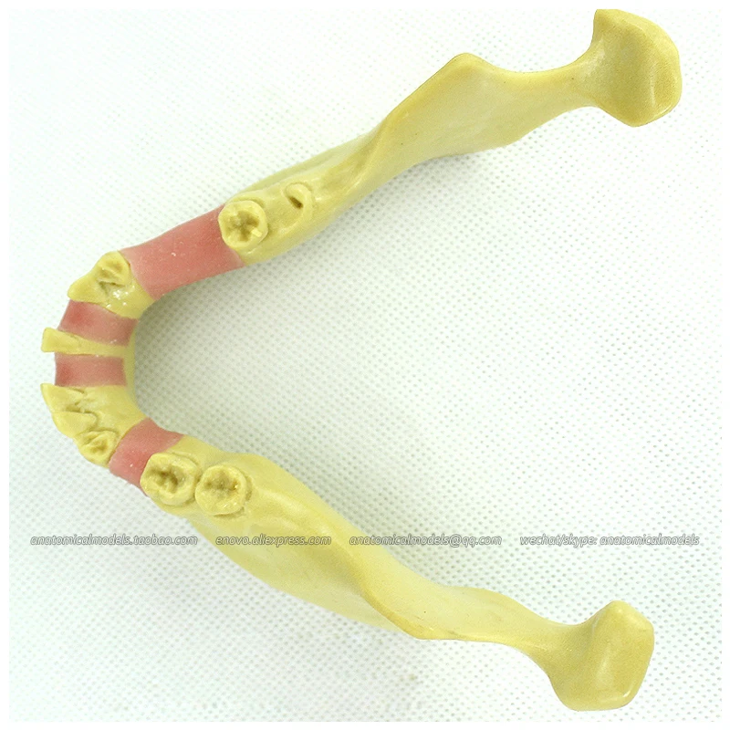

12619 / Dental Implant Missing Teeth Training Model, Lower Jaw Model
