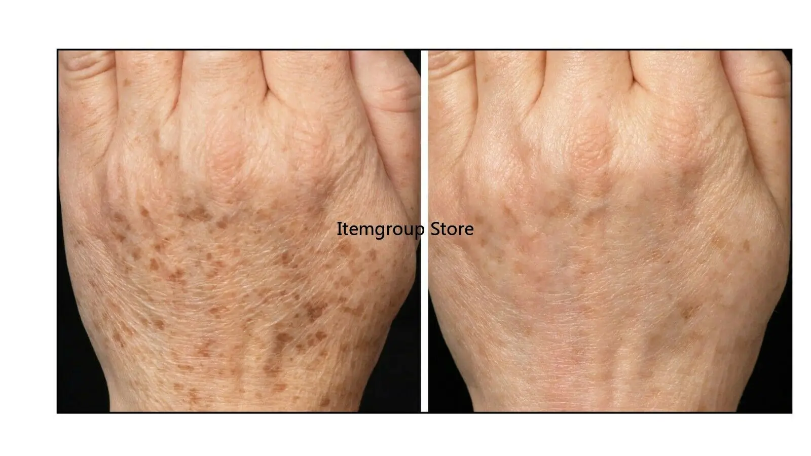 

Free Shipping 20%TCA Peel Medium Depth, Wrinkles, Age Spots, Crepey Skin 30ml
