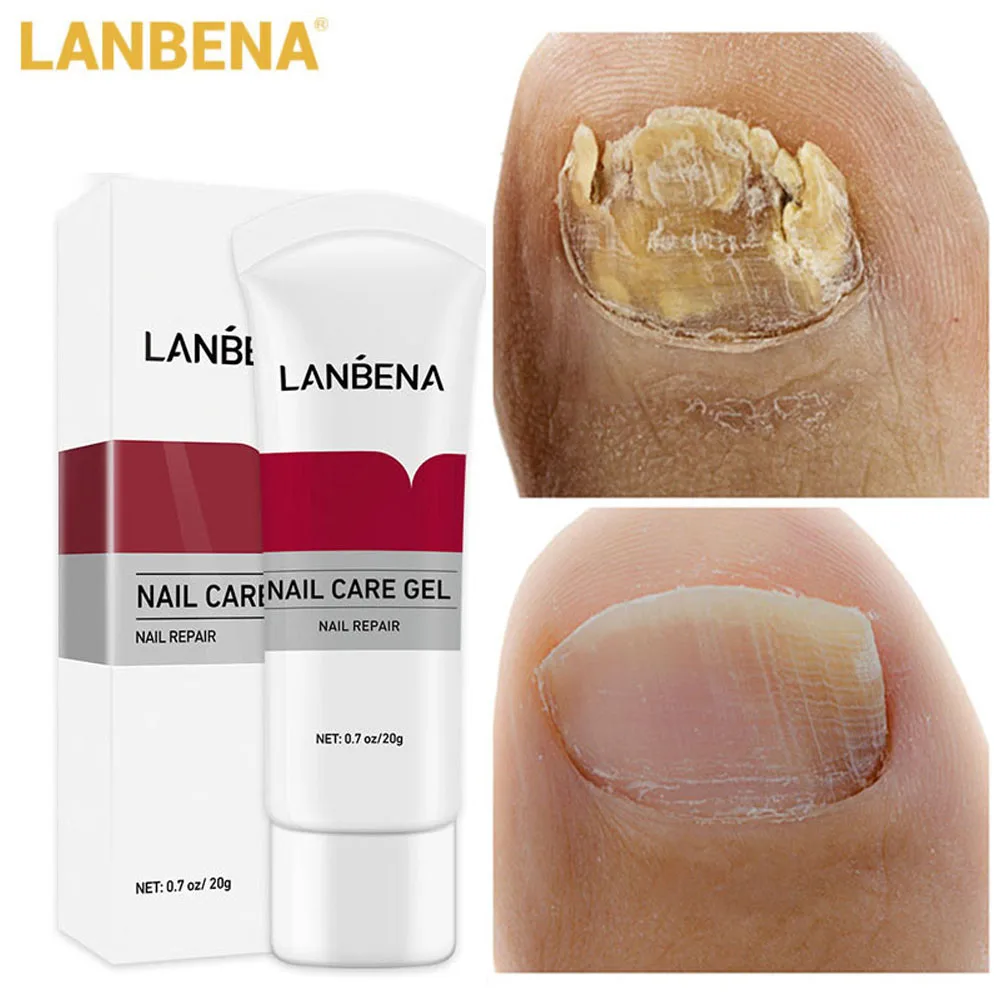 

LANBENA Nail Fungus Removal Crema Onychomycosis Fungal Nail Treatment Paronychia Anti Infection Feet Toe Fungal Nail Care Gel