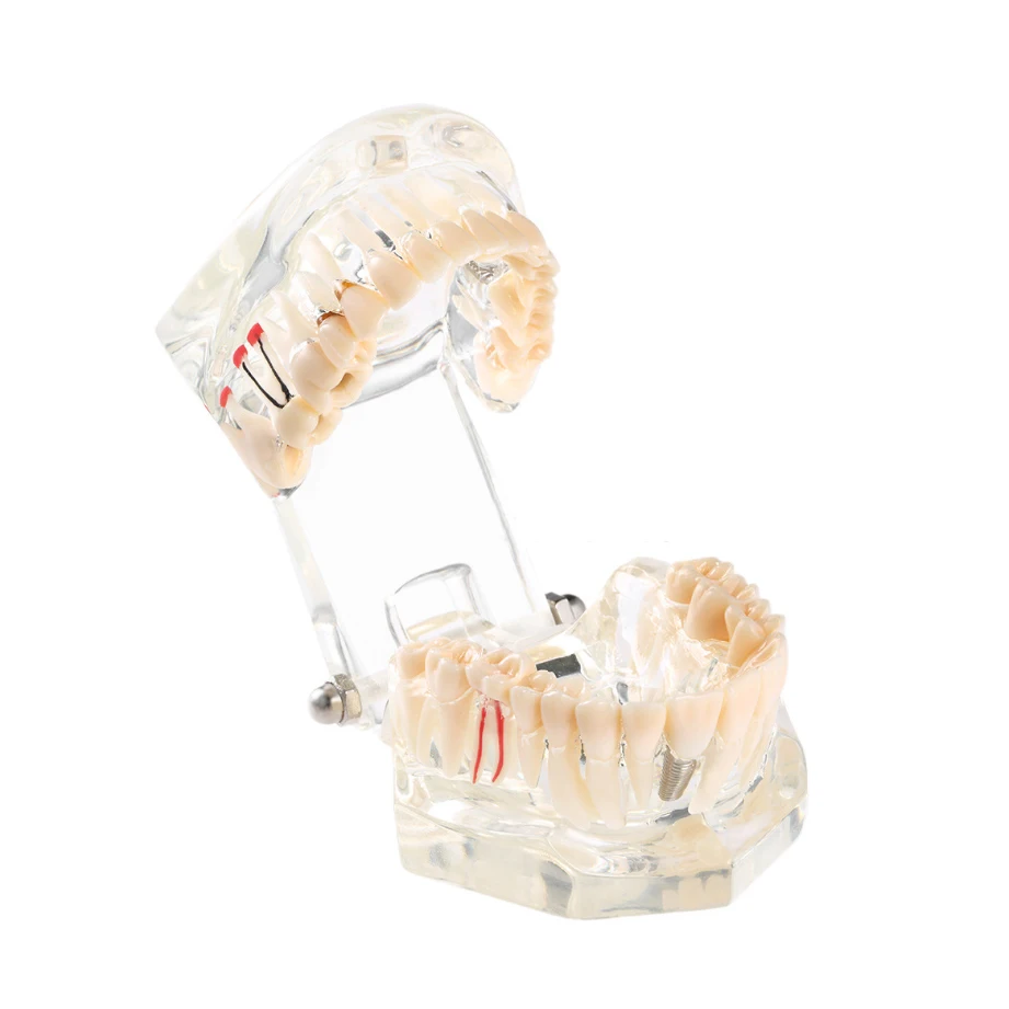 Горячая Распродажа зубной имплантат прозрачная модель удаляемых патологических
