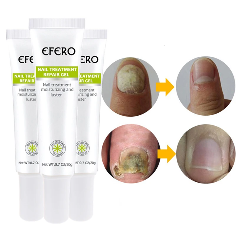 

1 Pc Anti Fungal Nail Treatment Cream Onychomycosis Nail Infection Feet Care