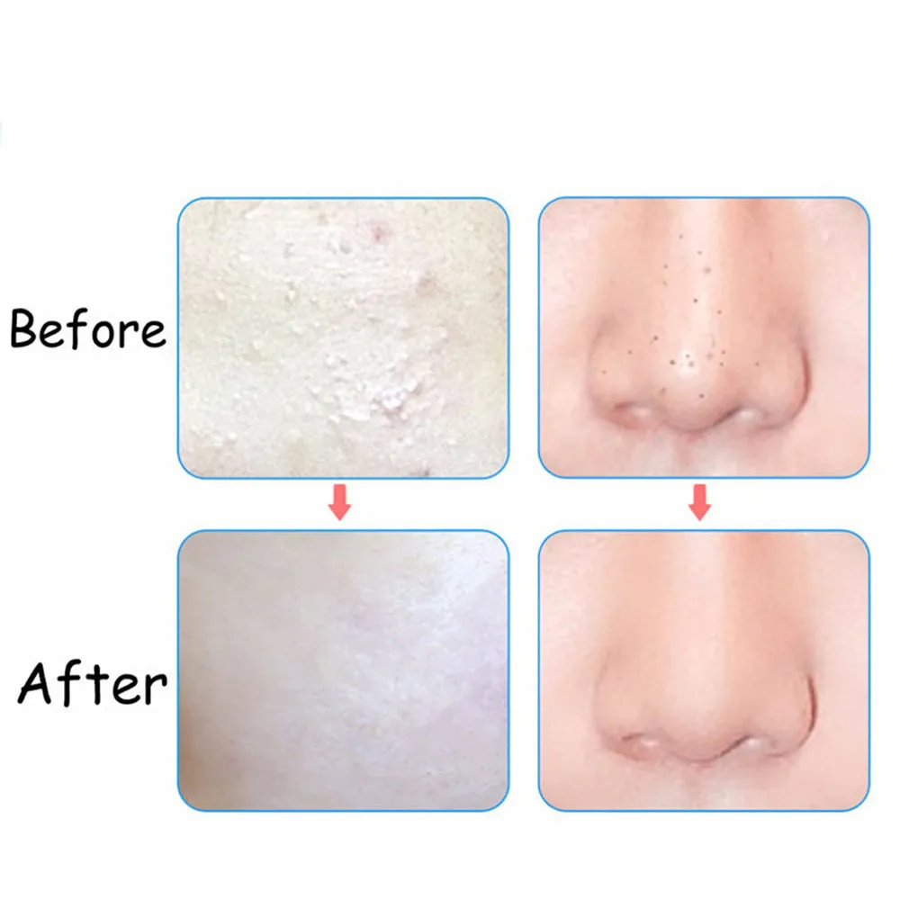 3 шт. пинцет для удаления чёрных точек из нержавеющей стали | Инструменты чистки