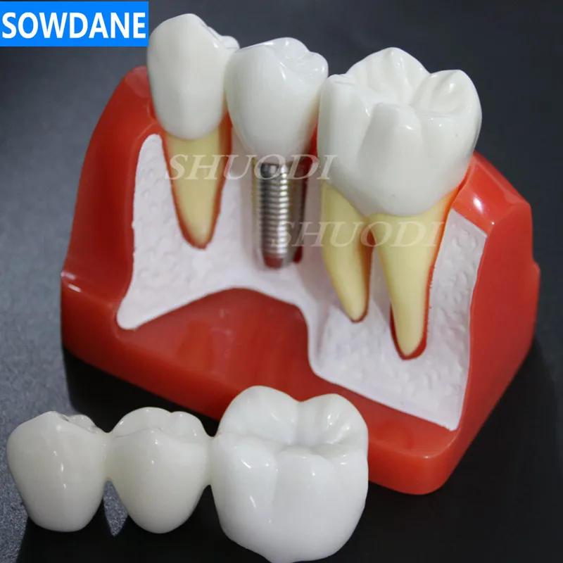 F 4 Times Implant Стоматологическая Исследование Учебная модель стоматологического Стандартный модель съемные зубы для взрослых и детей TYPODONT модель Стоматолог Связь модель - Цвет: F 4 Times Implant