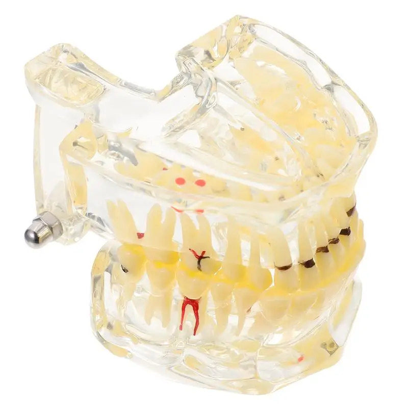 

1Pc Dental Implant Teeth Model Dental Restoration Model Demonstration Prop