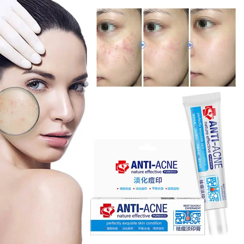 30g Acne Treatment Blackhead Remova Anti Cream Oil Control Shrink Pores Scar Remove Face Care Whitening TSLM1 |