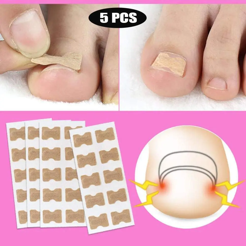 Пластырь для коррекции вросших ногтей клей пластырь наклейка инструменты
