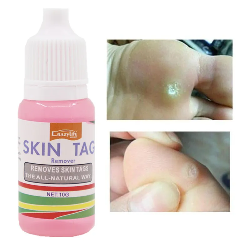 10 мл средство для удаления кожных следов естественное удаление бородавок жидкие