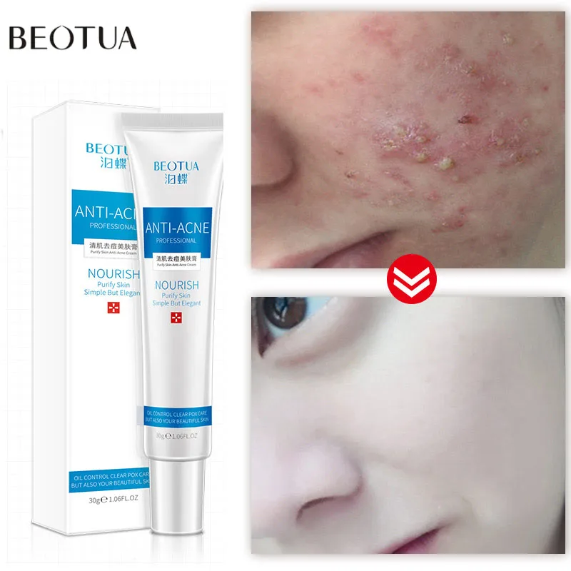 

Acne Removal Cream Effective Treatment Acne Scar Gel Fade Acne Spots Oil Control Shrink Pores Whiten Moisturiz Face Repair Care