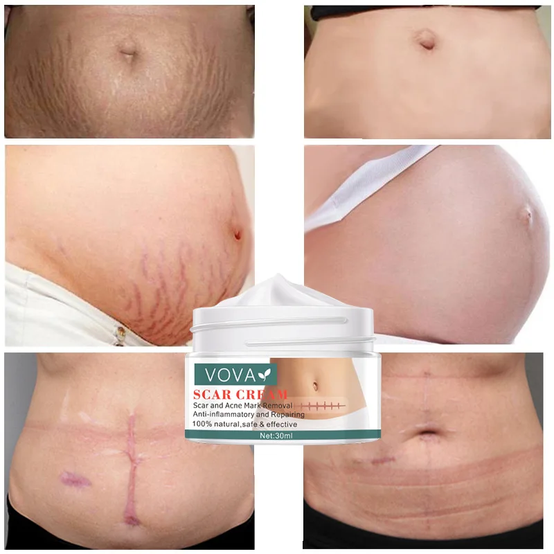 

Acne Scar Removal Cream Stretch Marks Remover Face Cream Smoothing Repairing Whitening Moisturizing Body Skin Care 30g