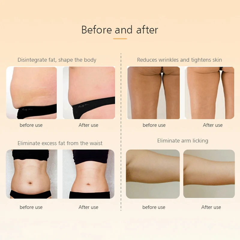 

NOHON RF& EMS Ultrasonic Cavitation Slimming Anti Cellulite Massager Body Radio Frequency Face Lifting Device