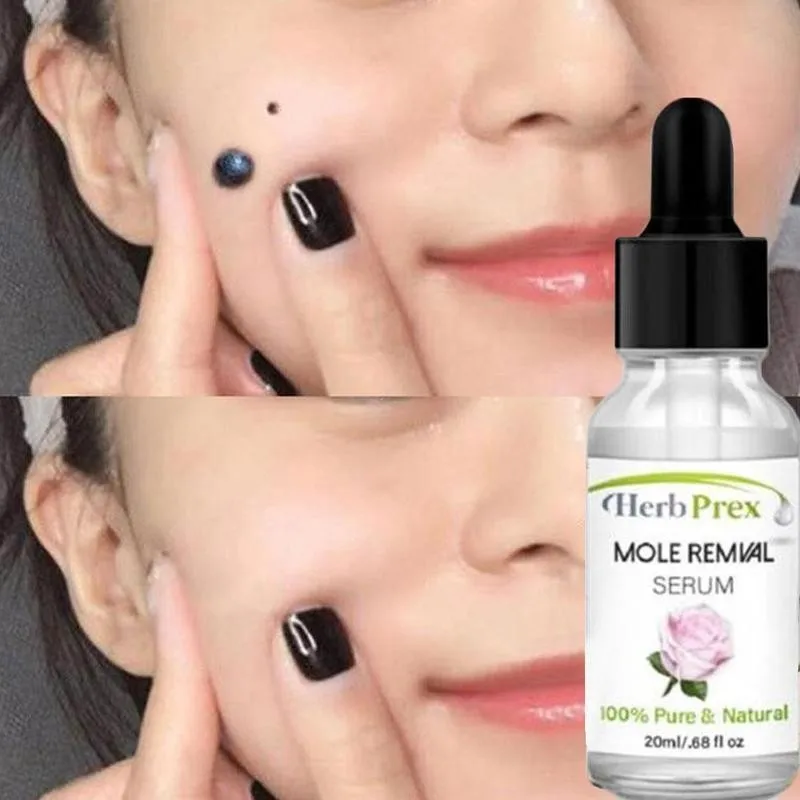 

No Trace Mole Removal Cream Essential Oil 20ml Organic Tags Solutions Serum Skin Tag Mole Freckle Spot Fast Remover Face Serum
