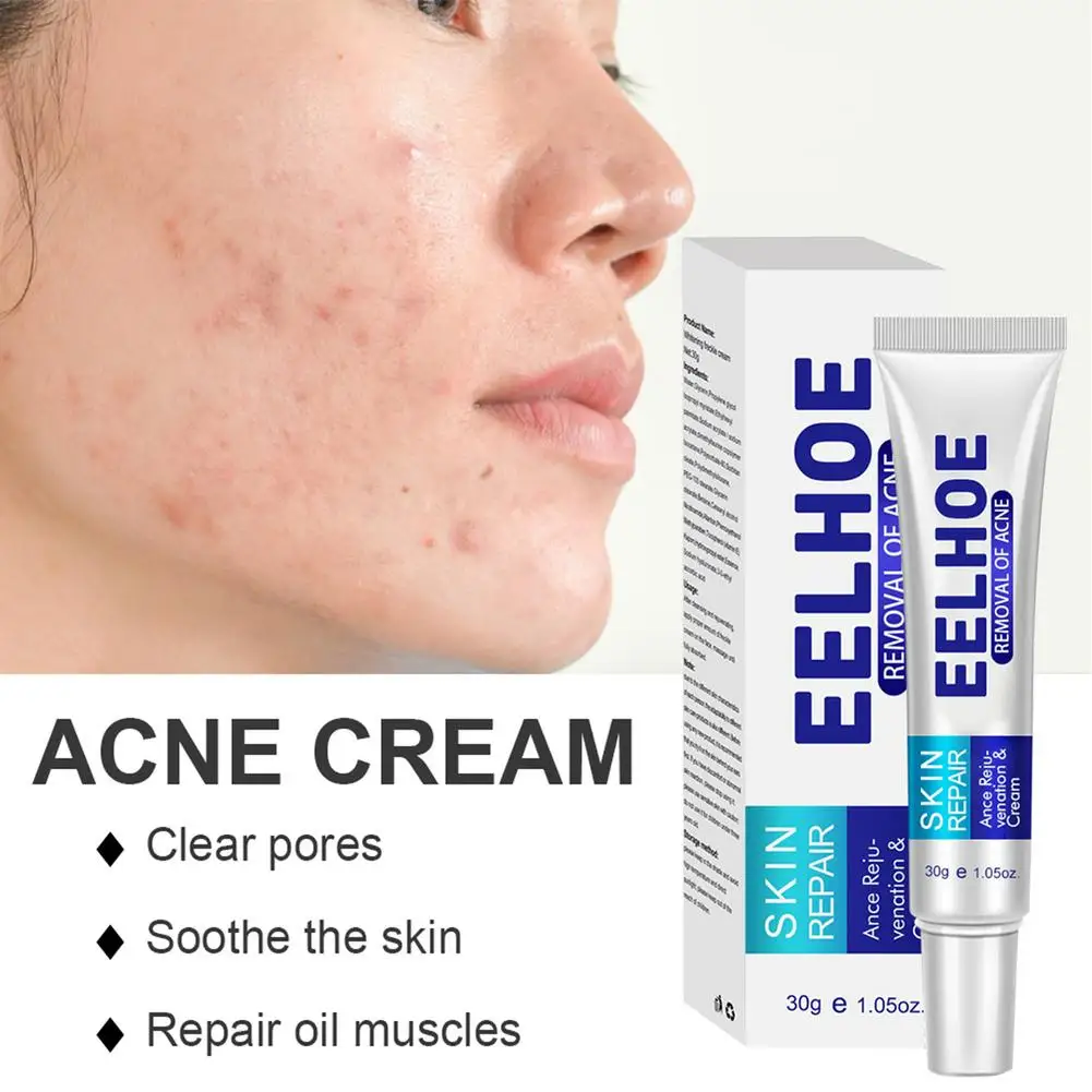 

Acne Cream Treatment Blackhead Remova Anti Acne Cream Oil Control Shrink Pores Acne Scar Remove Face Skin Care Whitening