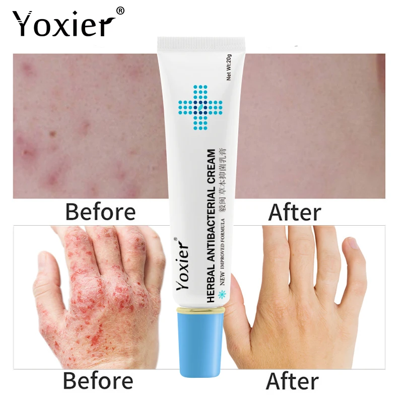 

Herbal Antibacterial Cream Skin Psoriasis Cream Dermatitis Eczematoid Eczema Ointment Anti-itch Relief Eczema Skin Treatment 20G