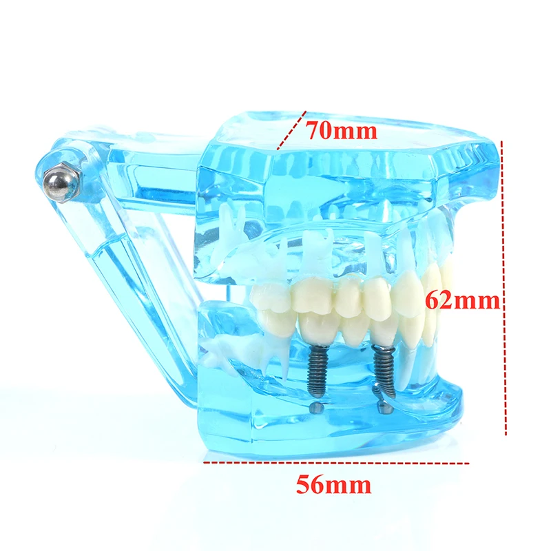 

1 Pcs Dental Model Teeth Implant Restoration Bridge Teaching Study Tooth Medical Science Disease Dentist Dentistry Products