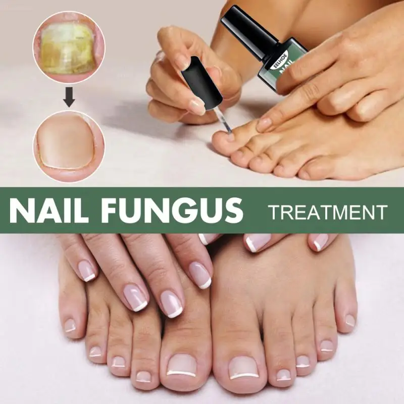 

Eelhoe 15ML Nail Repair Liquid Nail Therapy Pen Onychomycosis Paronychia Anti Fungal Nail Thickening Soft Nail Art TSLM2