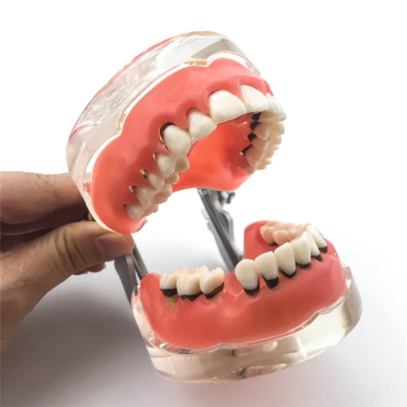 Модель зубов, модель зубов, модель для взрослых, патологическая, периодонтальная болезнь, модель модель