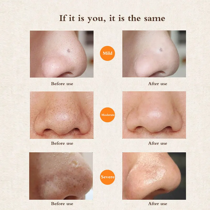 Прополис эссенция удаление черных точек маска набор глубокой очистки длительная