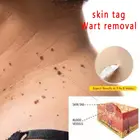 10 мл, этикетка для кожи, средство для ухода за кожей, Женская фотолампа 100%, полностью натуральное удаление ног, кукуруза для ухода за ногами TSLM1