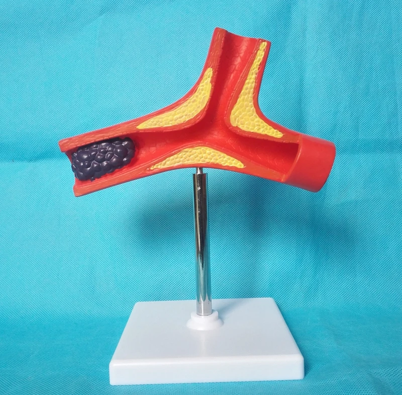 

Human Vascular Anatomy Model Pathological Blood Vessel Model Arteriosclerosis Thrombosis Arteries Atherosclerosis Medical Supply