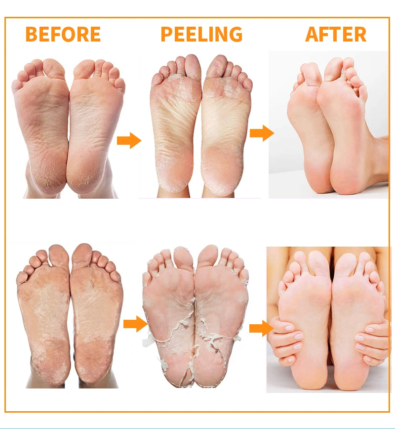 

6packs Exfoliating Foot Mask Socks for Pedicure Socks Feet Mask Spa Socks Care Remove Dead Skin Cuticles Heels Foot Peeling Mask