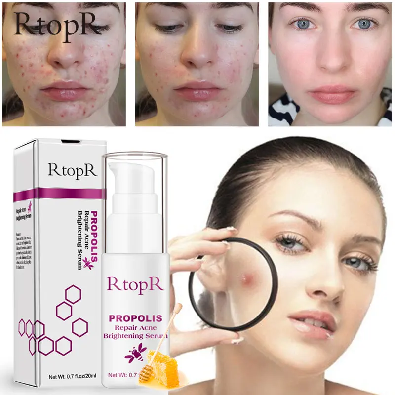 

RtopR Propolis Anti-Acne Brightening Serum Acne Scar Spots Removal Essence Shrink Pores Eliminates Acne-Treatment Oil-Control