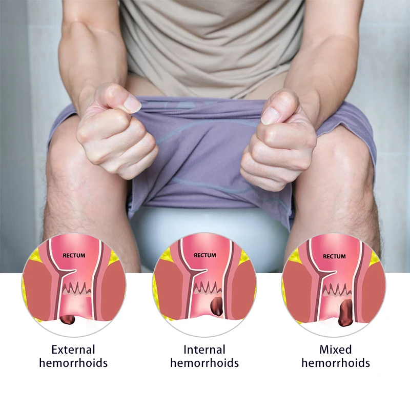 Китайский медицинский крем для лечения геморроя 20 г | Красота и здоровье