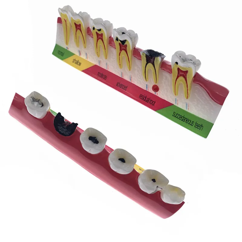 

Dental caries classify Tooth Model of pathological process around teeth caries Evolution decayed Model