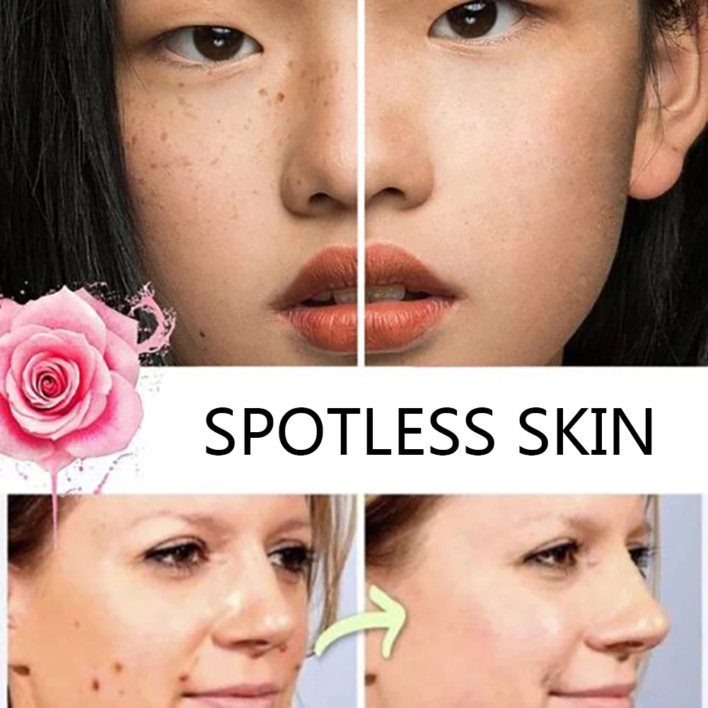 

20Ml Whitening and Anti-Freckle Essence Remove Serum Skin Tag Mole Femoval Serum Remover Face Serum Organic Tags Solutions