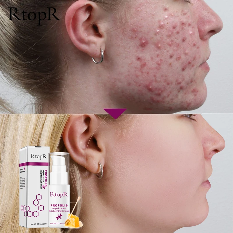 Ртопр прополис ремонт акне осветляющая сыворотка шрам пятна очищающая сужение