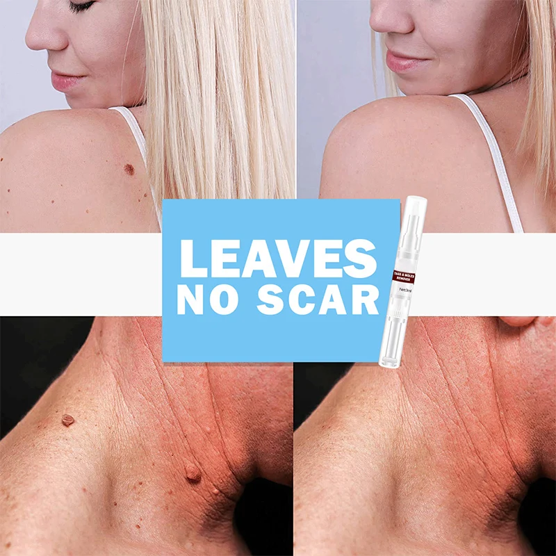 

Tags and Moles Remover Removes Skin Tag and Moles Gently Rejuvenate Skin M88